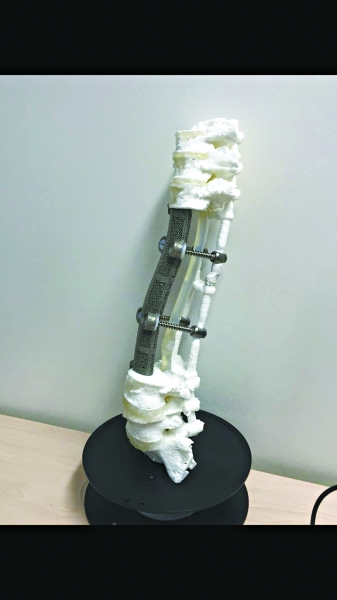 世界首个3D打印人工脊椎植入成功