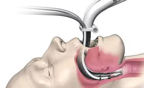 头颈外科手术更简单 蛇形机器人应用引关注