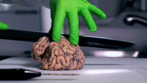 英国大脑银行解剖捐献者大脑：为医学研究提供重要资源